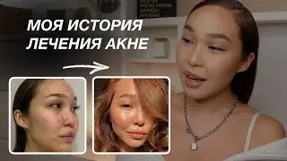 МОЯ ИСТОРИЯ: как я вылечила акне?