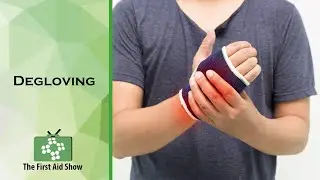 Degloving