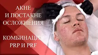 💉The effectiveness of Plasma therapy for Acne and post-acne complications.