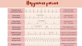 Норма и патология на ЭКГ: Нарушения Ритма