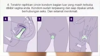 Cara memakai kondom wanita yang benar