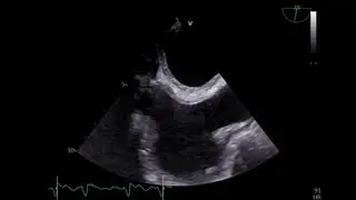 Isolated atrial #amyloidosis (IAA) a diagnostic & therapeutic challenge