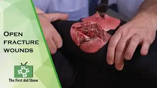 Open fracture wounds on The First Aid Show