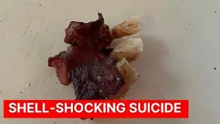 Shell-Shocking Suicide