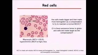 Myelodysplastic syndrome (MDS) and anemia