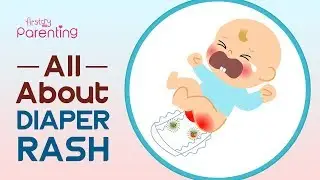 Diaper Rash in Babies –  Symptoms, Causes and Remedies