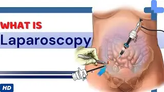 What Is Laparoscopy?