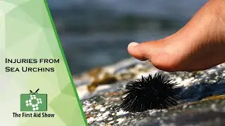 Dealing with Sea Urchin Stings: Safety Tips and Treatment Methods in UK Coastal Waters