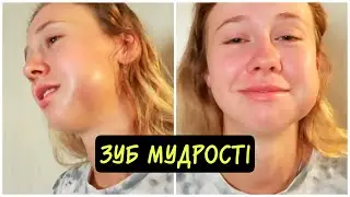 Vlog Видалила зуб мудрості || Як це було || Розрізали ясна