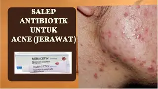 Salep antibiotik untuk acne vulgaris (jerawat) #salepkulit #antibiotics #acnetreatment #obat