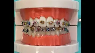 Orthodontic Ties and Wire