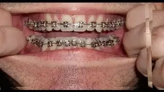 Braces - Photo taken every day - Before and After Transformation - Orthodontics Timelapse