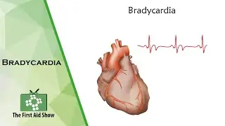 Bradycardia