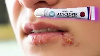 Mengatasi Herpes Oral dengan Menggunakan Salep Acyclovir