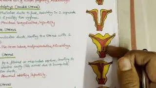 Uterine Anomalies - Easy Handwritten Notes