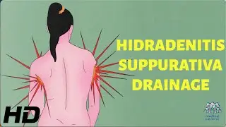 Hidradenitis Suppurativa Drainage: How to Minimize Pain and Discomfort