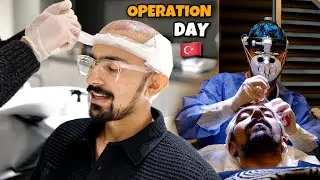 MY HAIR TRANSPLANT IN ISTANBUL TURKEY - Smile Hair Clinic - Part 2