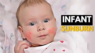 How To Prevent and Treat Infant Sunburn?