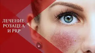 💉ROSACEA and COOPEROSIS| Possibilities of plasma therapy for stage I rosacea