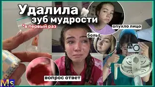 УДАЛЯЮ ЗУБ МУДРОСТИ || самая сложная неделя в моей жизни || мой опыт+вопрос ответ