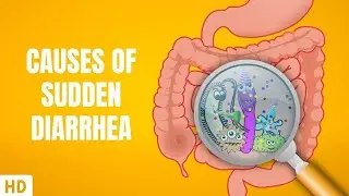 Causes of Sudden Diarrhea