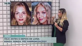 Veja antes e depois dos famosos que fizeram harmonização facial