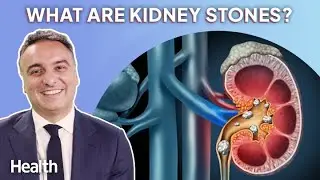 Urologist Answers YOUR Questions About Kidney Stones | Ask An Expert | Health