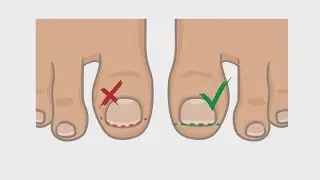 How to Best Handle and Treat an Ingrown Toenail