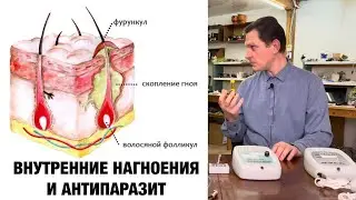 Внутренние Нагноения и Антипаразит с Катушкой Мишина Тор-2. Как вылечить чирий, фурункул?