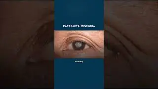 Главная причина катаракты.