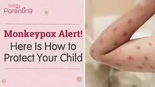 Monkeypox In Children - Symptoms, Risks and Safety Tips