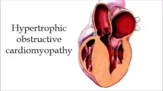 Hypertrophic Obstructive Cardiomyopathy (HOCM)