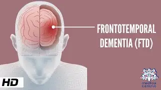 Frontotemporal Dementia, Causes, Signs and Symptoms, Diagnosis and Treatment.