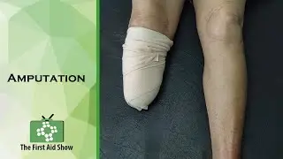 Amputation