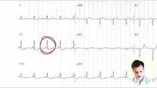 ЭКГ за 100 минут №8: Синдромы на ЭКГ