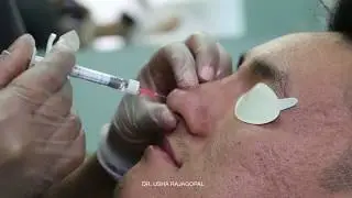 Male Non-Surgical Nose Job in San Francisco | Dr. Usha Rajagopal